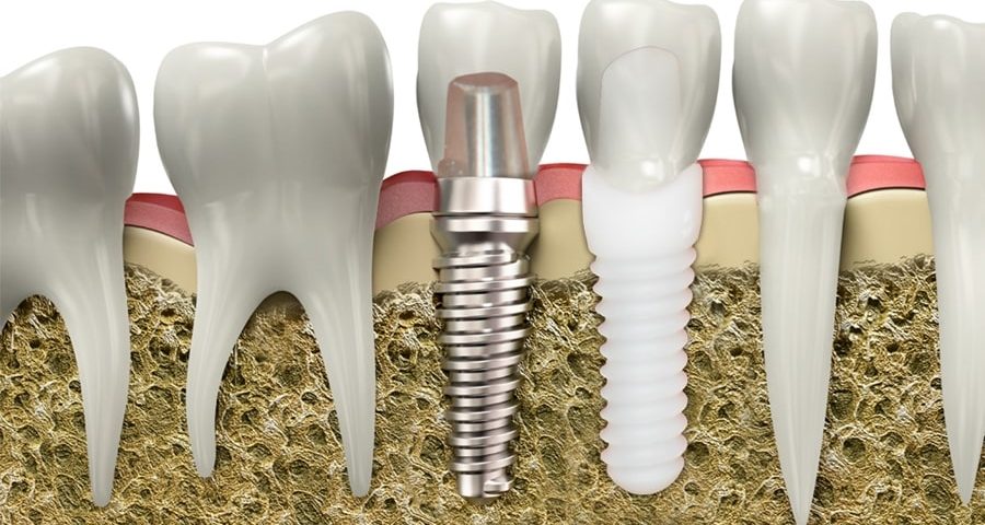 Dental Implants | Dental Alvarez
