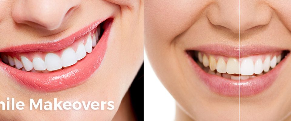 Smile Makeovers | Dental Alvarez