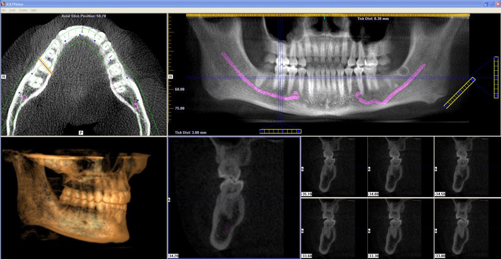 Dental Implant - Dental Alvarez