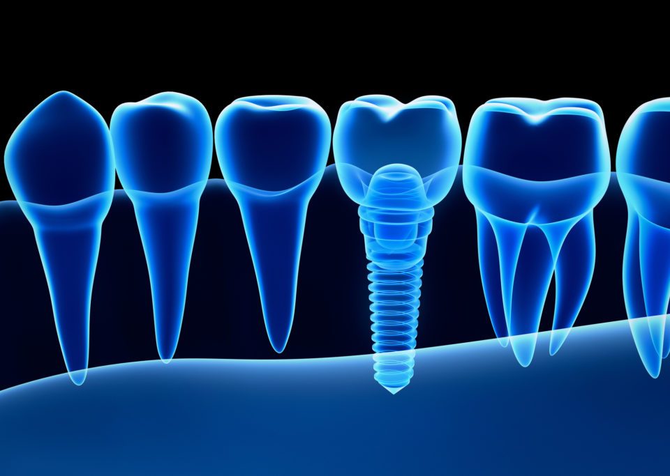 Dental Implant - Dental Alvarez