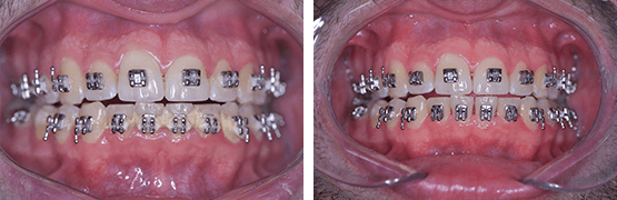 dental-cleaning-braces-before-and-after-tijuana