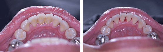 dental-cleaning-calculus-before-and-after-tijuana