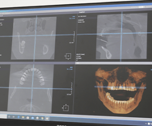 digital-implant-planning-at-our-dental-clinic