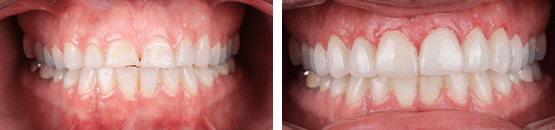 porcelain-dental-crowns-veneers-tijuana-before-and-after