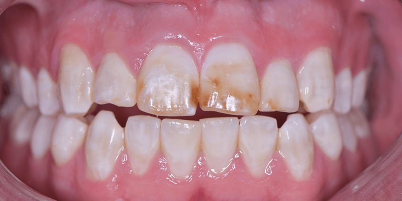 how-to-prevent-your-children-from-developing-fluorosis-in-teeth