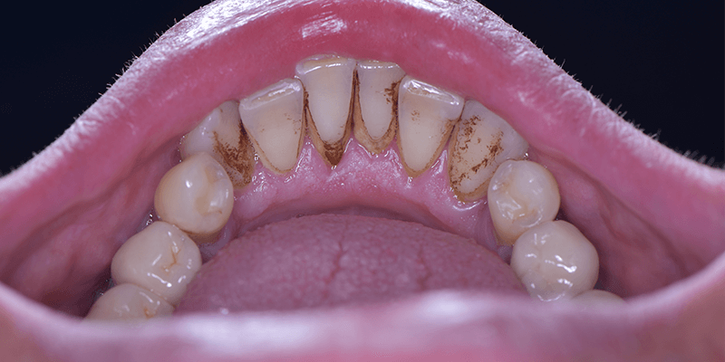 reasons-for-a-coffee-stain-on-teeth-to-appear-and-how-to-solve-them
