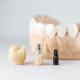 why-dental-implant-care-after-surgery-is-important