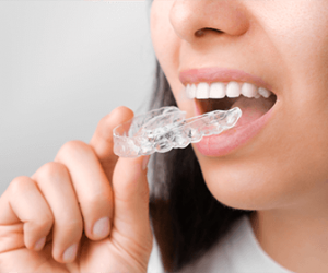 do-you-need-retainer-after-braces-types-of-retainers