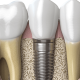 dentalalvarez-what-is-bone-graft-material-made-of