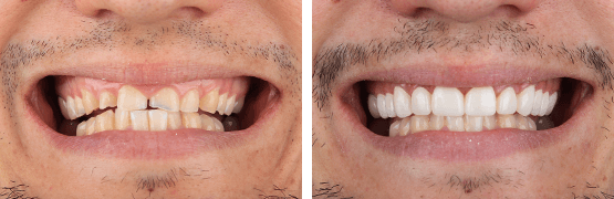 dentalalvarez-before-and-after-complete-rehabilitation-metal-free-crowns-patient-with-severe-wear
