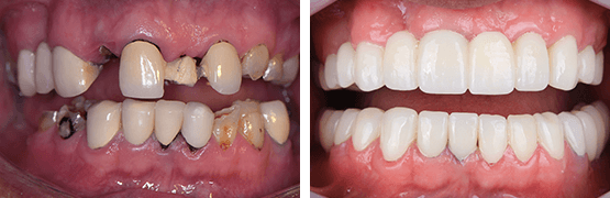 dentalalvarez-before-and-after-complete-restoration-patient-with-loss-of-dental-pieces