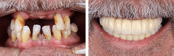 dentalalvarez-before-and-after-implant-supported-zirconia-prosthesis