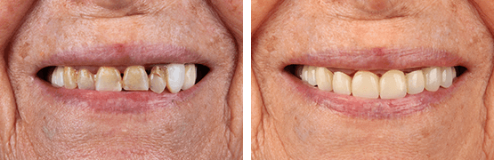 dentalalvarez-before-and-after-metal-free-crowns-complete-rehabilitation