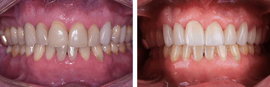 dentalalvarez-before-and-after-metal-free-crowns-patient-with-pigmentation-and-receded-gums