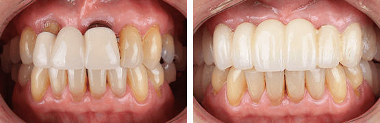 dentalalvarez-before-and-after-metal-free-dental-crowns