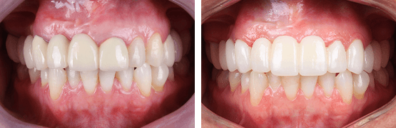 dentalalvarez-before-and-after-replacement-of-crowns-to-zirconia-porcelain-bridge