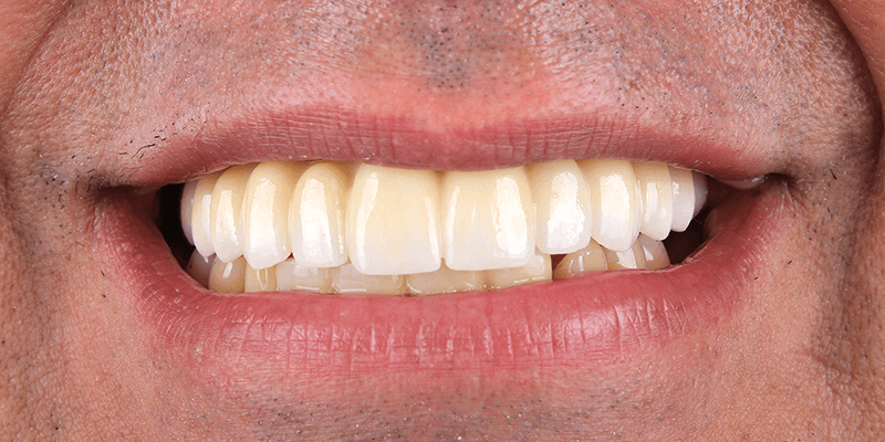 dentalalvarez-all-on-four-dental-implants