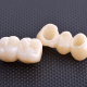 dentalalvarez-dental-bridge-vs-implant-cost-in-tijuana