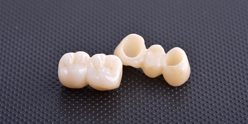 dentalalvarez-dental-bridge-vs-implant-cost-in-tijuana
