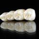 dentalalvarez-how-to-start-cleaning-your-dental-implant-bridge