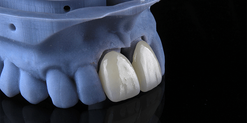 dentalalvarez-high-quality-dental-crowns-for-front-teeth-in-tijuana
