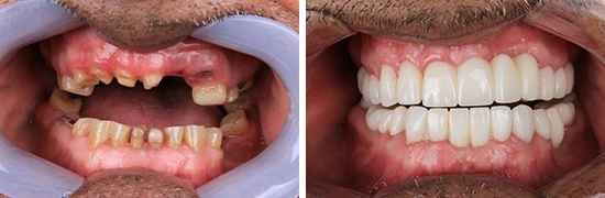 b&a-complete-rehabilitation-of-upper-and-lower-dentalalvarez