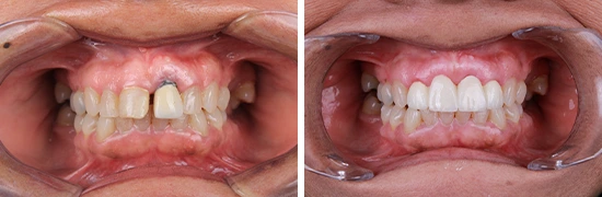 b&a-dental-implants-dentalalvarez