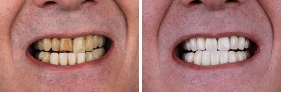 b&a-rehabilitation-treatment-on-the-upper-and-lower-teeth-dentalalvarez