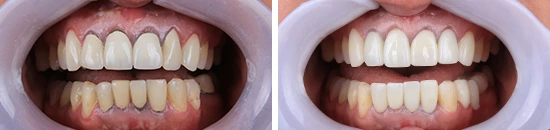 b&a-replacement-of-crowns-upper-and-lower-part-of-jaw-dentalalvarez