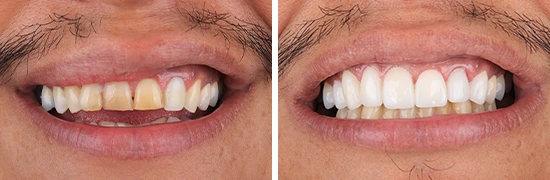 b&a-smile-makeover-dental-transformation-dentalalvarez