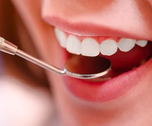 how-long-do-dental-sealants-last