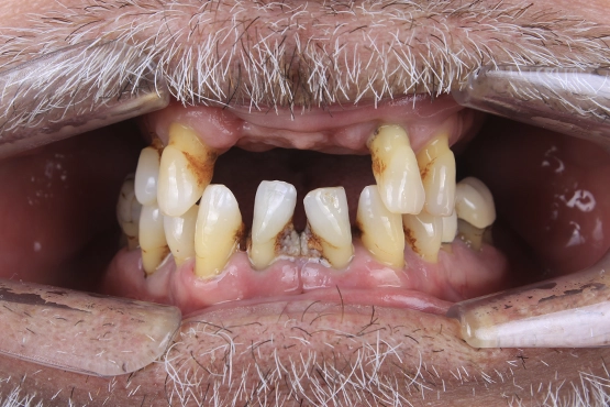 01-all-on-4-dental-implants-before-and-after-dental-alvarez