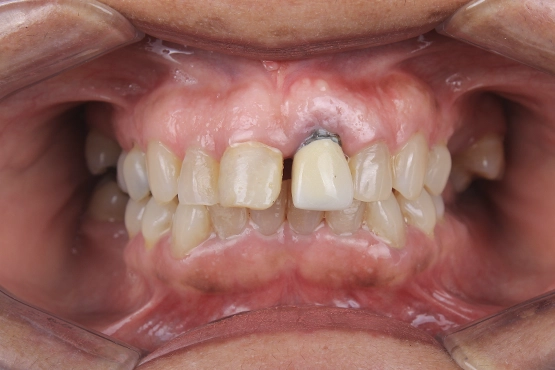 01-dental-implants-before-and-after-dental-alvarez