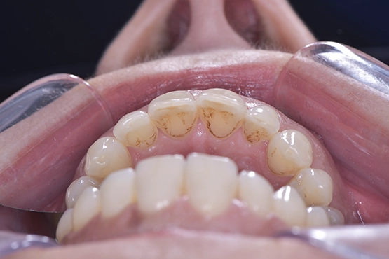 01-general-dental-cleaning-before-and-after-dental-alvarez
