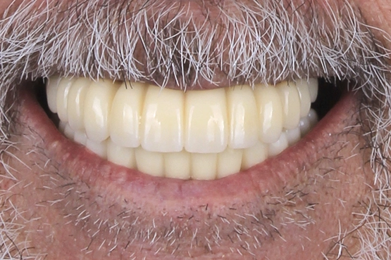 02-all-on-4-dental-implants-before-and-after-dental-alvarez