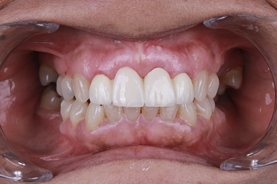 02-dental-implants-before-and-after-dental-alvarez