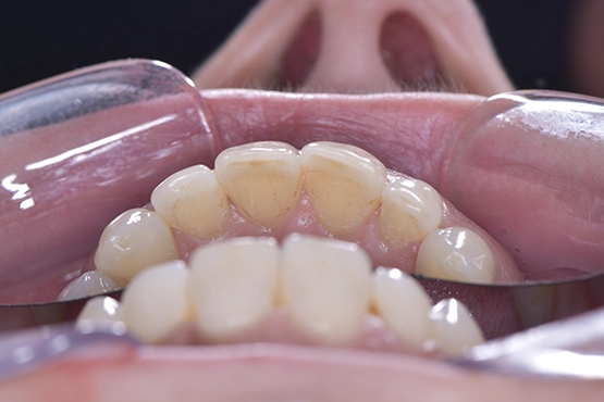 02-general-dental-cleaning-before-and-after-dental-alvarez