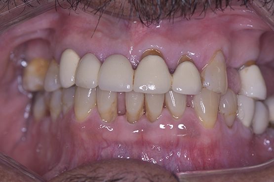 03-all-on-4-dental-implants-before-and-after-dental-alvarez