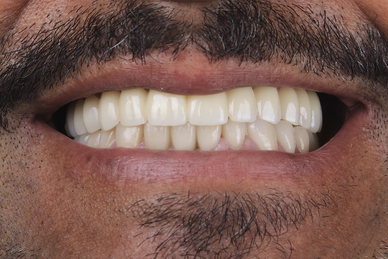 04-all-on-4-dental-implants-before-and-after-dental-alvarez