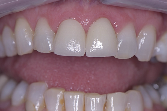 04-crowns-before-and-after-dental-alvarez