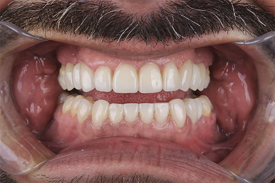 04-smile-makeover-before-and-after-dental-alvarez