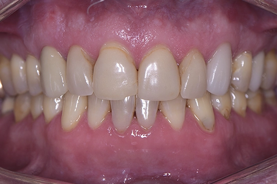 05-crowns-before-and-after-dental-alvarez