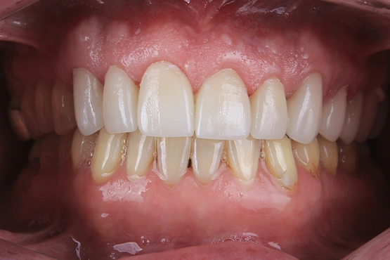 06-crowns-before-and-after-dental-alvarez