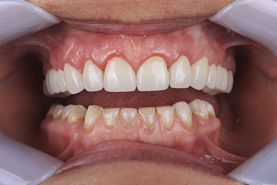 06-smile-makeover-before-and-after-dental-alvarez