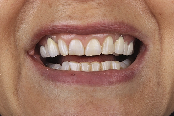 07-smile-makeover-before-and-after-dental-alvarez