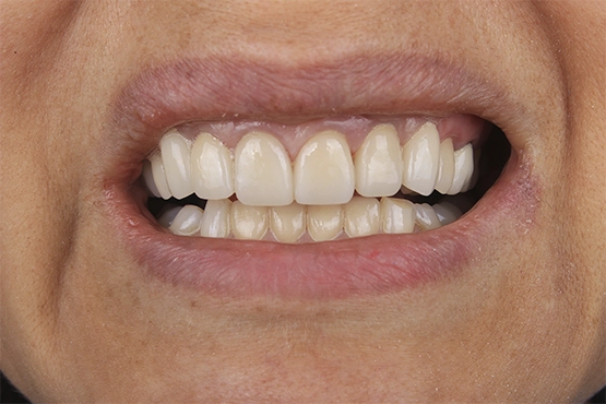 08-smile-makeover-before-and-after-dental-alvarez