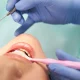how-long-does-tooth-filling-last-and-how-to-extend-lifespan-dental-alvarez-tijuana
