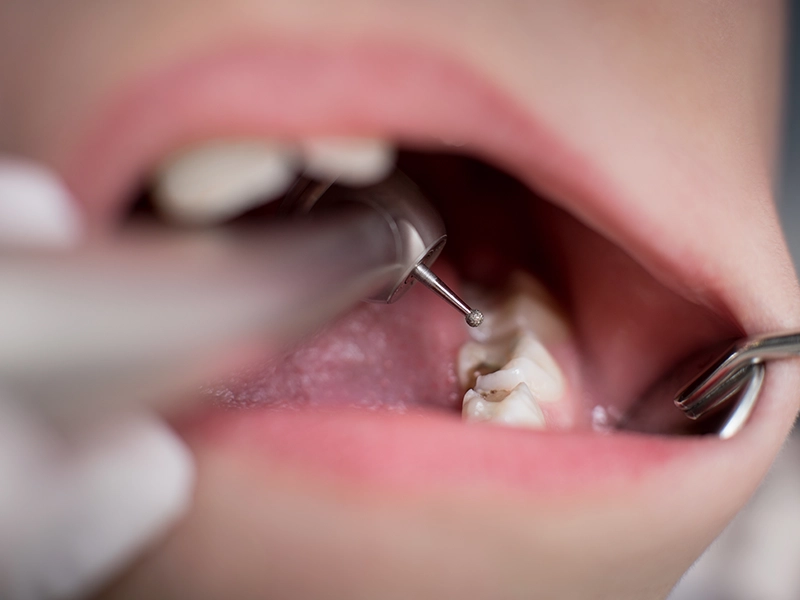 how-painful-is-a-root-canal-during-and-after-treatment-dental-alvarez-tijuana