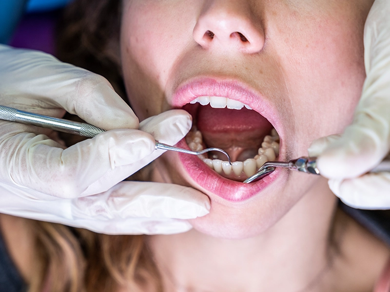 what-is-a-dental-filling-made-of-and-how-long-does-it-last-dental-alvarez-tijuana
