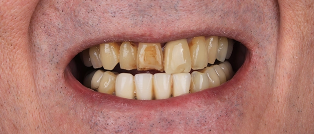 healthy-smile-understanding-dental-erosion-and-abrasion